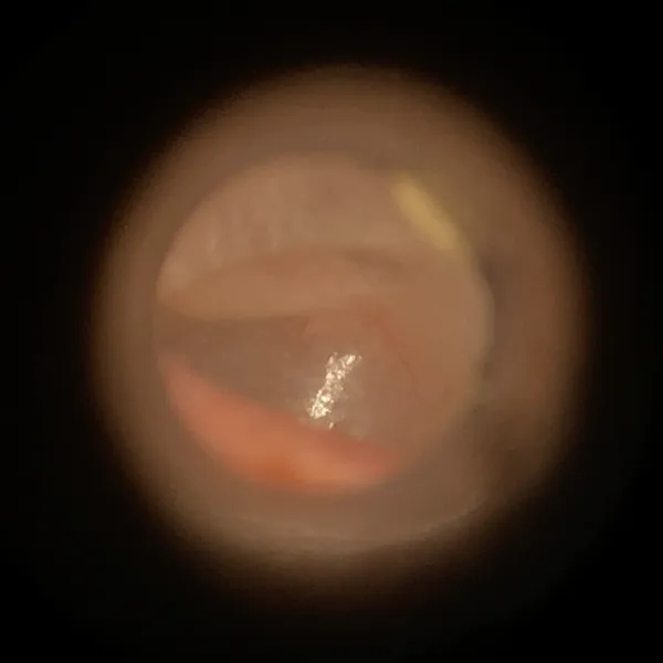 Microsuction Ear Wax Removal - After
